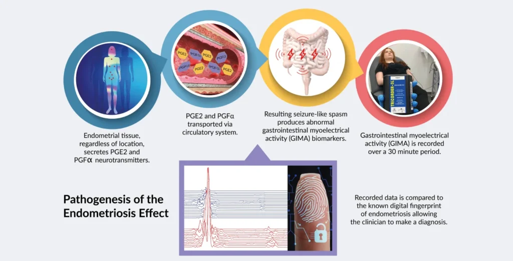 pathogenesis of the endometriosis effect (1)